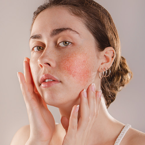 woman with rosacea on her cheeks